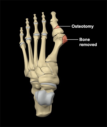 Foot Reconstruction
