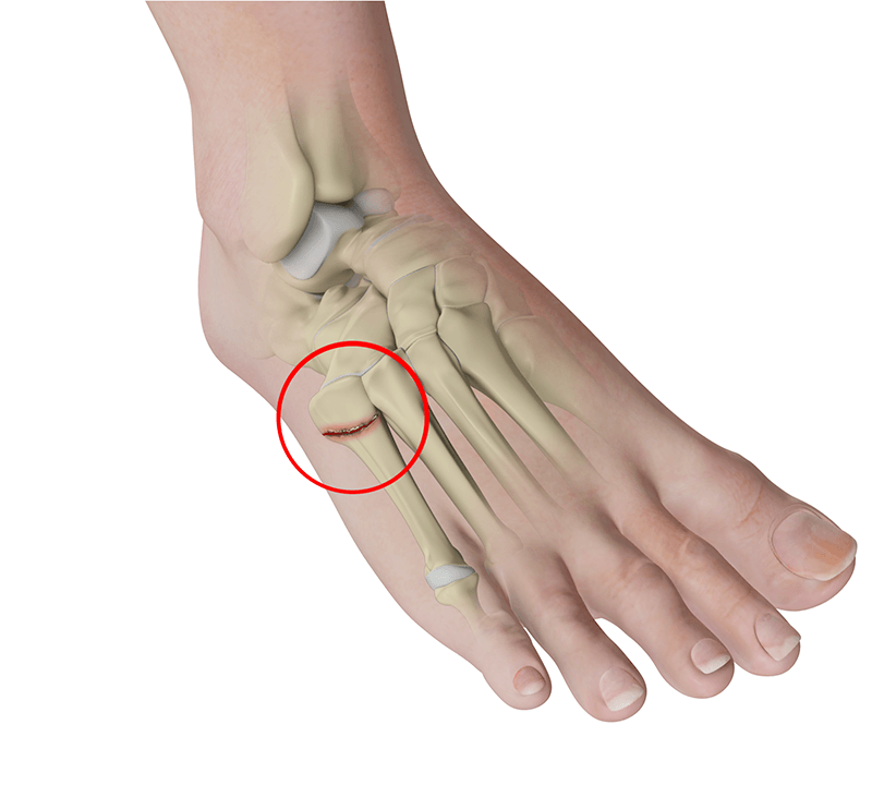 Jones Fractures (5th Metatarsal)