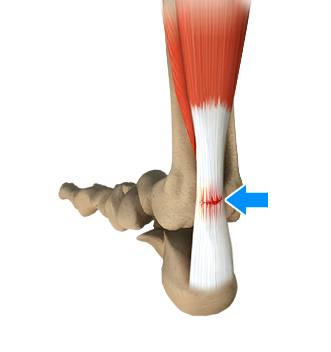 Achilles Tendon Rupture