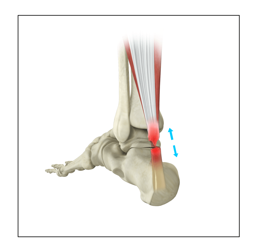 Achilles Tendon Rupture