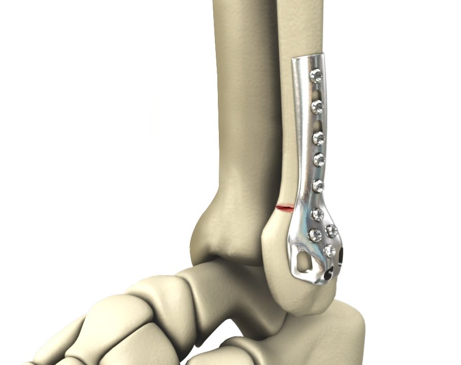 ankle fracture surgery
