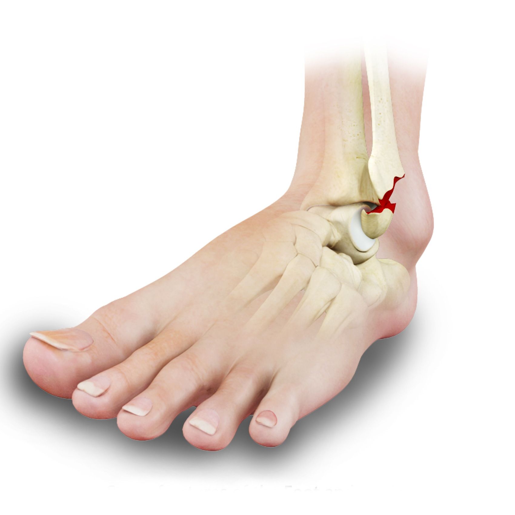 Ankle Fracture Repair Los Angeles Broken Ankle Glendale Pasadena