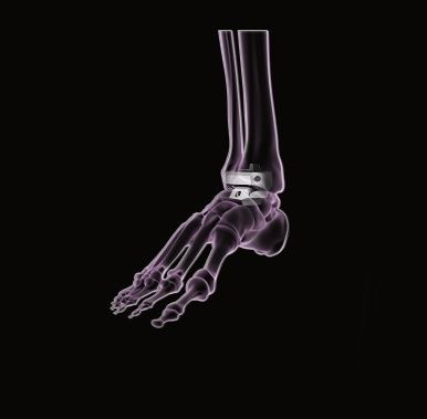 Ankle Replacement Surgery Los Angeles | Ankle Arthritis Treatment La Canada