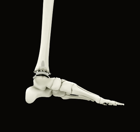 Ankle replacement