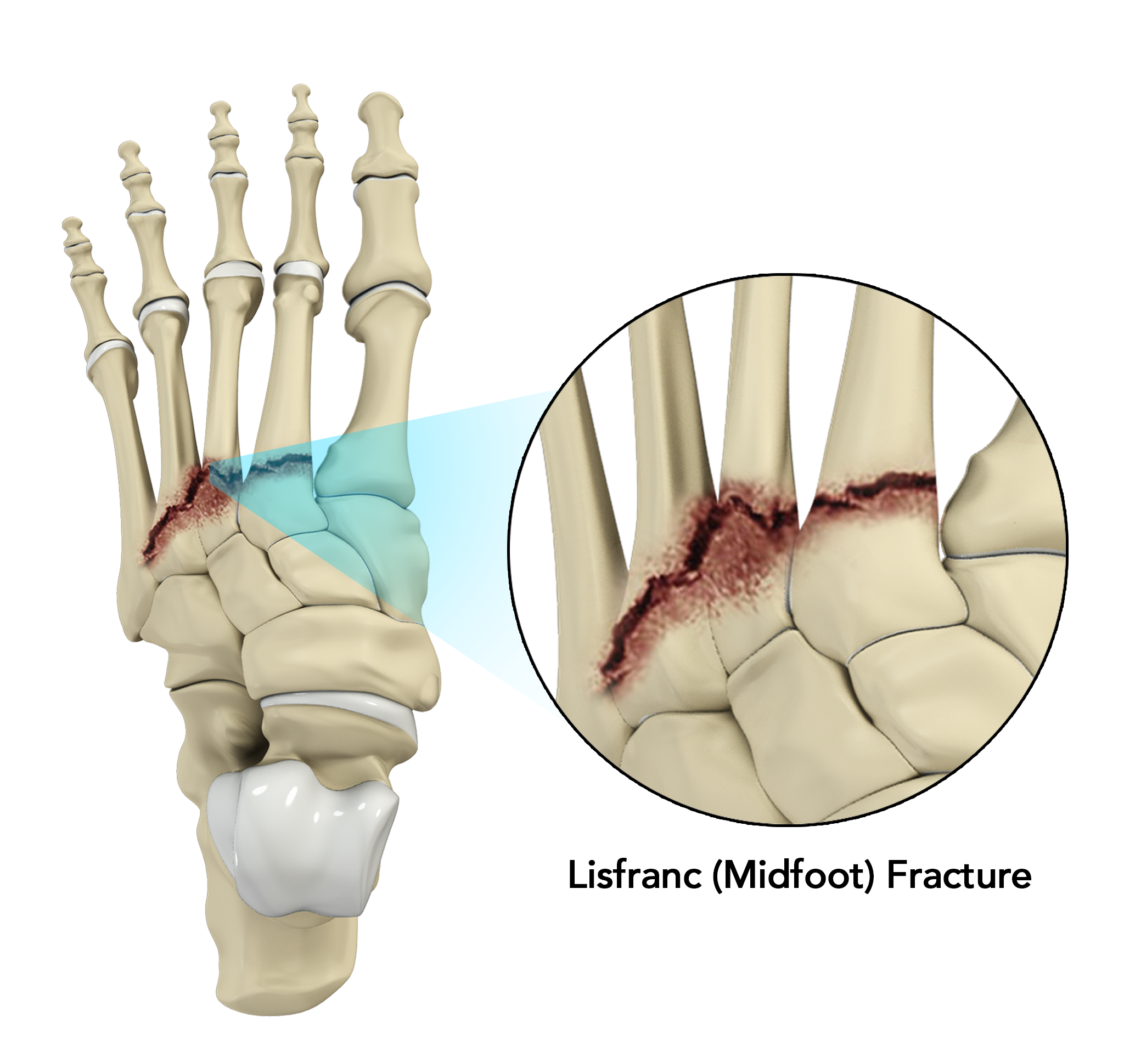 Lisfranc Fracture