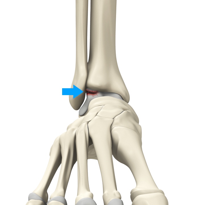 Osteochondral Lesions