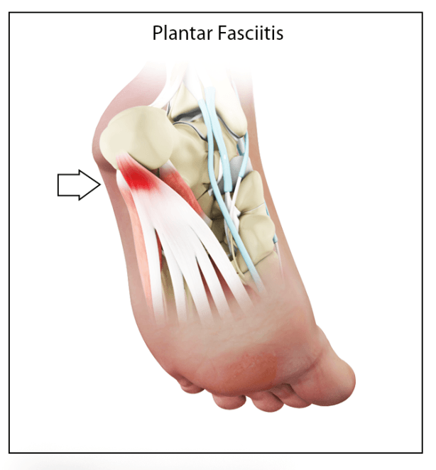 Plantar Fasciitis  Diagnosis, Causes & Treatments