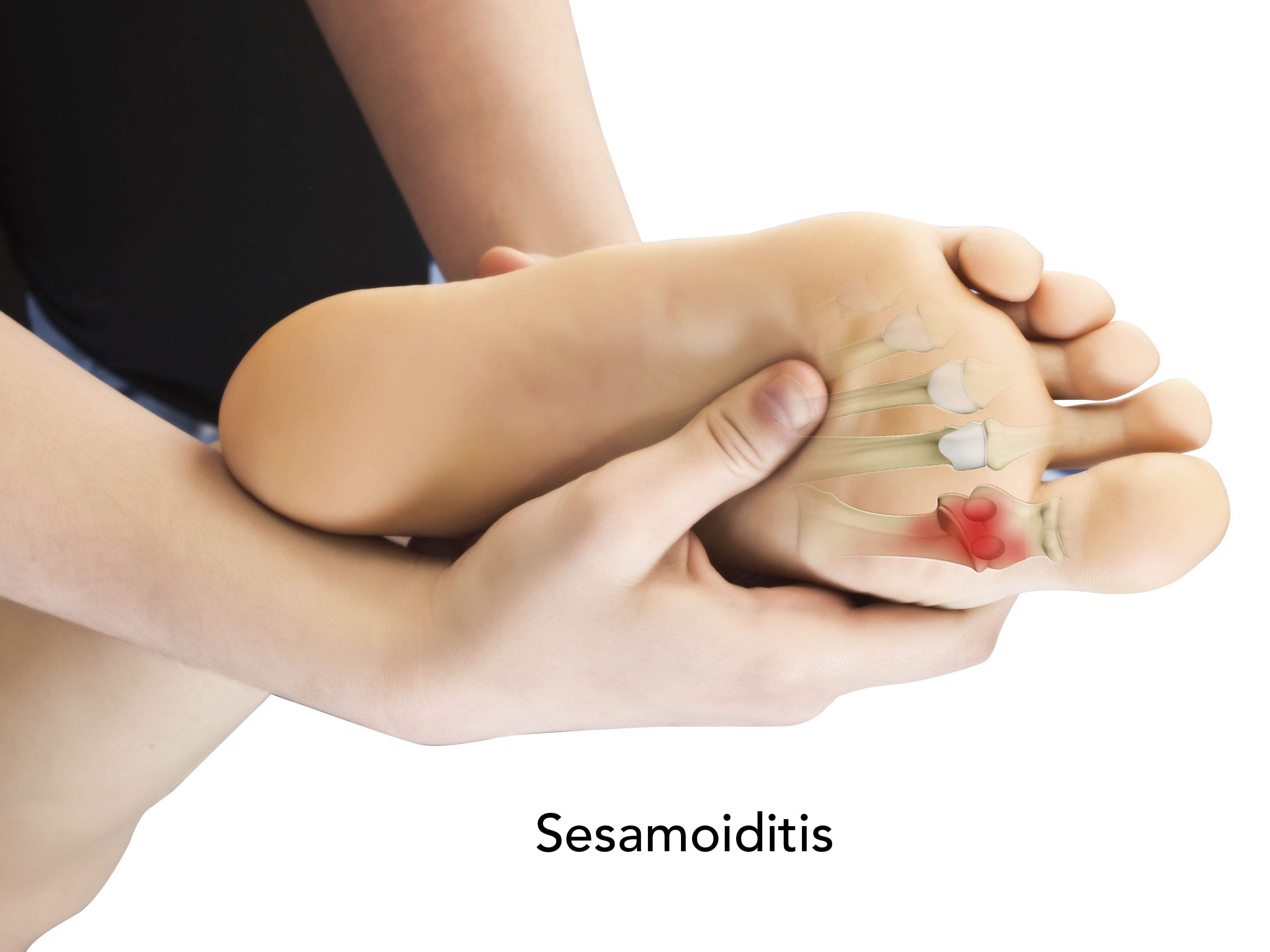 Sesamoid