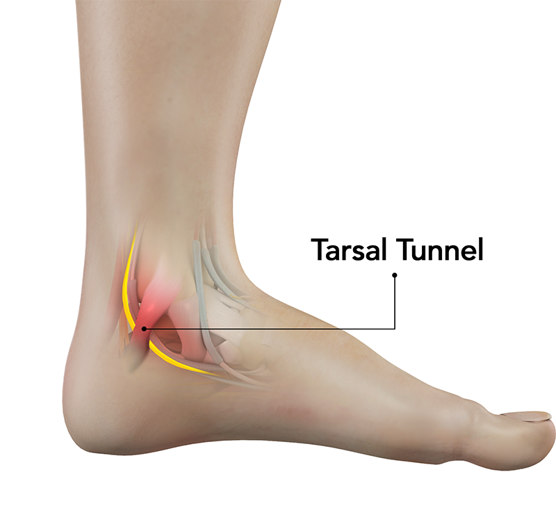 Tarsal Tunnel Syndrome